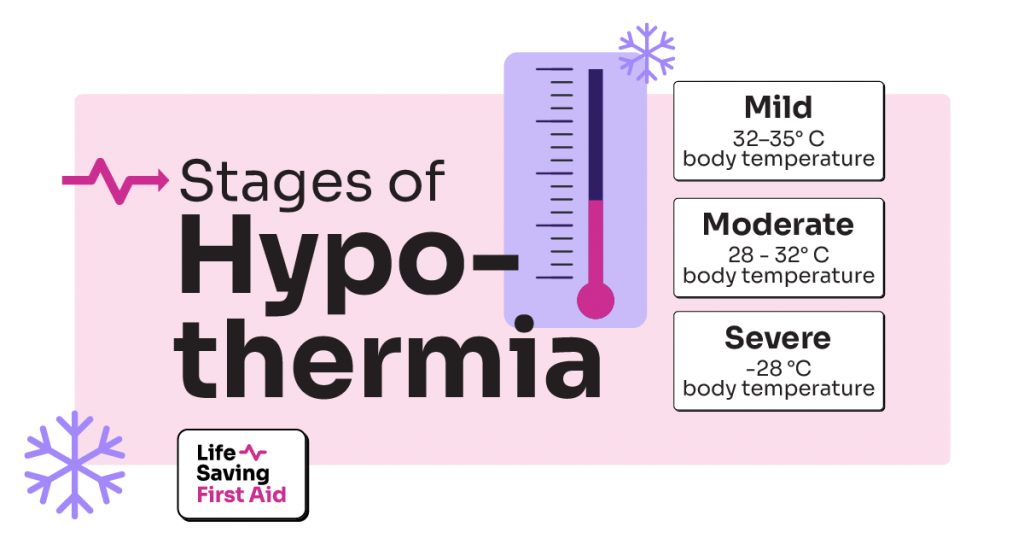 Stages of hypothermia. Mild hypothermia: 32 to 35 °C body temperature. Moderate hypothermia: 
 28 to 32° C body temperature. Severe hypothermia: Less than 28° C body temperature.