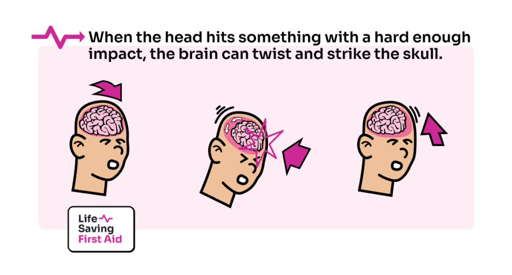When the head hits something with a hard enough impact, the brain can twist and strike the skull.