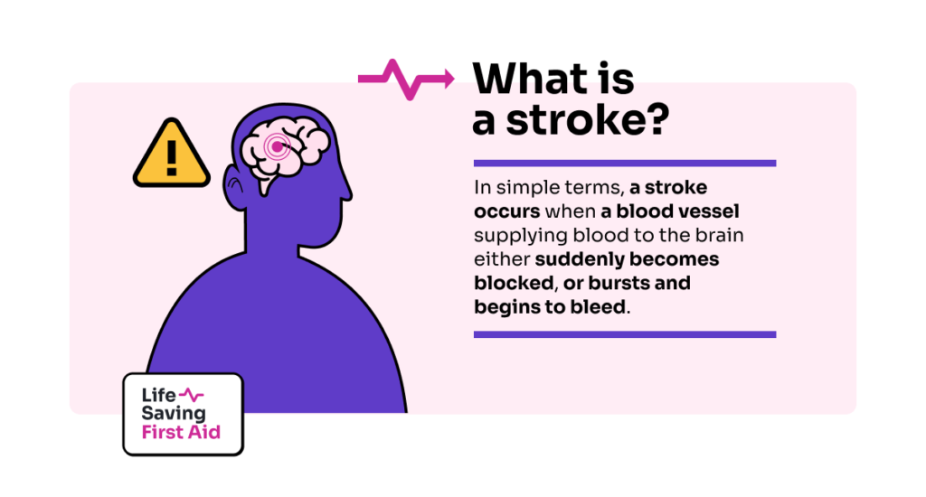 What is a stroke? In simple terms, a stroke occurs when a blood vessel supplying blood to the brain either suddenly becomes blocked, or bursts and begins to bleed.