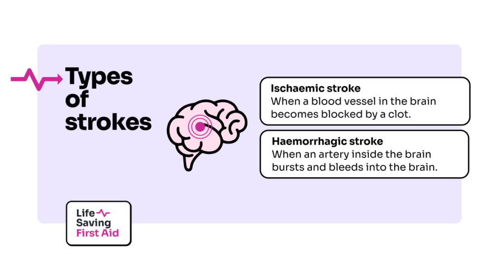 Types of strokes. Ischaemic stroke.
When a blood vessel in the brain becomes blocked by a clot. Haemorrhagic stroke.
When an artery inside the brain bursts and bleeds into the brain.