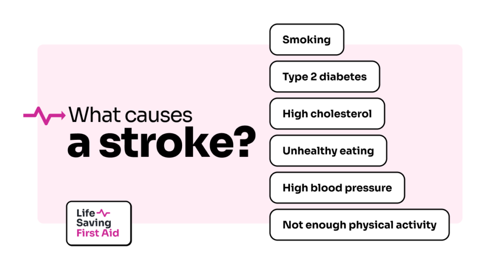 What causes a stroke?
Smoking, Type 2 diabetes, High cholesterol, Unhealthy eating, High blood pressure and Not enough physical activity.